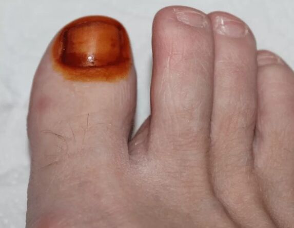 Θεραπεία του μύκητα ιωδίου