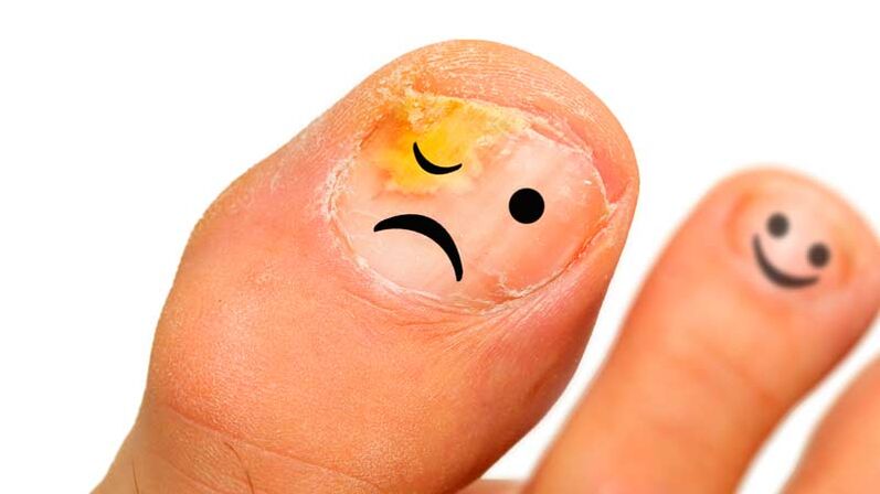 Μύκητας νυχιών