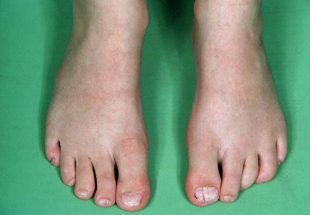 Ο μύκητας στα πόδια