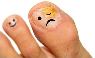 κίτρινος μύκητας των νυχιών των ποδιών