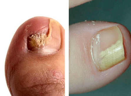 Μυκητιακή ασθένεια