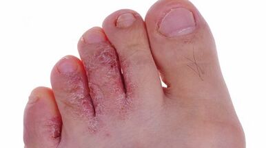 Τύποι και στάδια της ανάπτυξης των μύκων στα πόδια