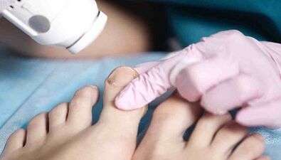 θεραπεία υλικού του μύκητα στα πόδια