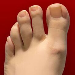 Μύκητας νυχιών