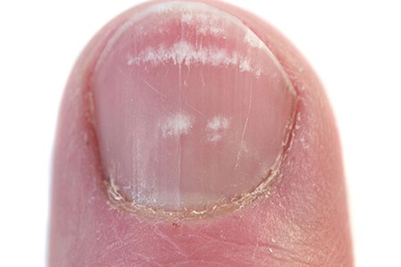 Τα πρώτα σημεία και συμπτώματα