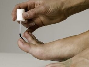 Θεραπεία του μύκητα νυχιών