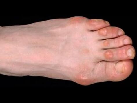 μύκητας στο πόδι